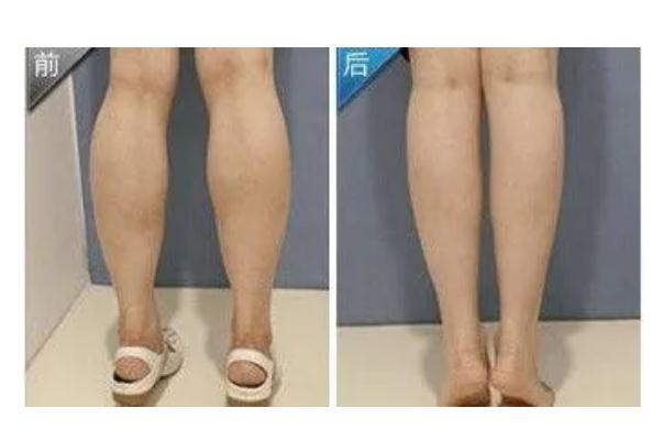 瘦腿針的原理 瘦腿針的危害有什么副作用 瘦腿針的原理 瘦腿針的危害有什么副作用