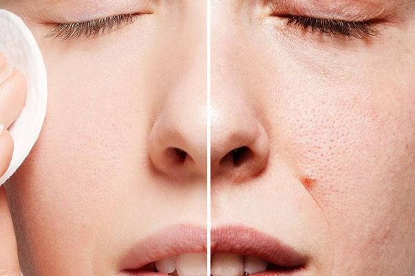 毛孔粗大會自己好嗎 毛孔粗大會導(dǎo)致什么后果