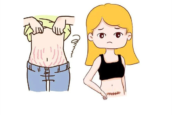 妊娠紋用激光可以去除掉嗎 妊娠紋激光手術(shù)多少錢(qián)