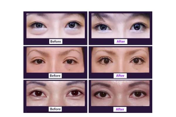 去眼袋手術(shù)的風(fēng)險(xiǎn) 去眼袋手術(shù)是睜眼做嗎 去眼袋手術(shù)的風(fēng)險(xiǎn) 去眼袋手術(shù)是睜眼做嗎