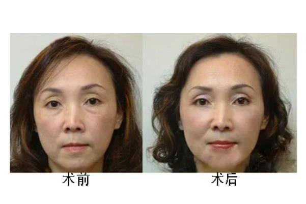 去眼袋手術后注意事項 去眼袋手術要多久恢復正常