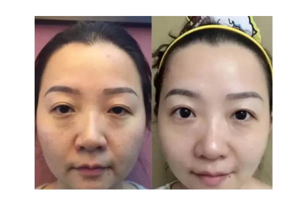 去眼袋手術后注意事項 去眼袋手術要多久恢復正常