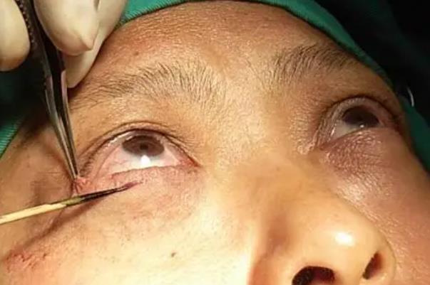 去眼袋手術(shù)費(fèi)用大概多少錢(qián) 去眼袋手術(shù)有危害嗎