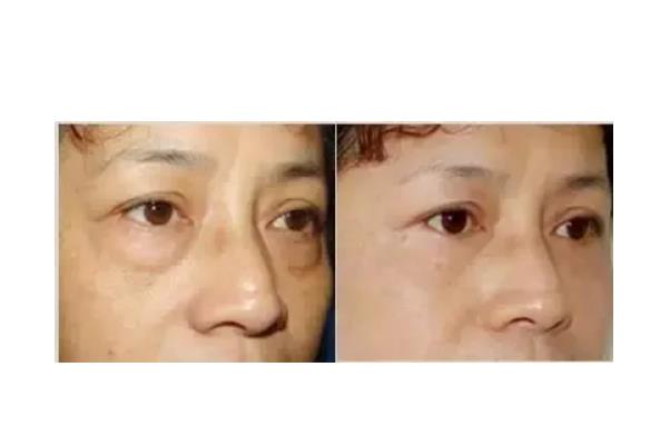 去眼袋手術會把臥蠶去掉嗎 去眼袋手術對眼有傷害嗎 去眼袋手術會把臥蠶去掉嗎 去眼袋手術對眼有傷害嗎