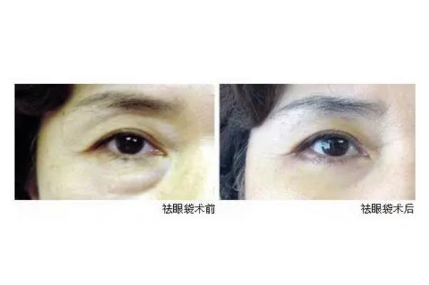 去眼袋手術(shù)是全麻還是局麻 去眼袋手術(shù)是內(nèi)切好還是外切好 去眼袋手術(shù)是全麻還是局麻 去眼袋手術(shù)是內(nèi)切好還是外切好