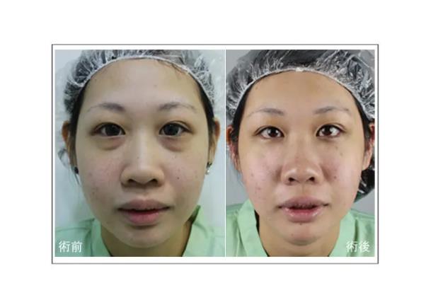 去眼袋手術會把臥蠶去掉嗎 去眼袋手術對眼有傷害嗎 去眼袋手術會把臥蠶去掉嗎 去眼袋手術對眼有傷害嗎