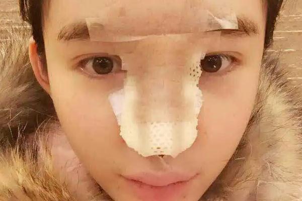 耳軟骨隆鼻有什么后遺癥 耳軟骨隆鼻有點歪可以調整嗎