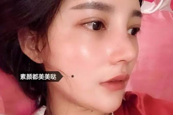 耳軟骨隆鼻有什么后遺癥 耳軟骨隆鼻有點歪可以調整嗎