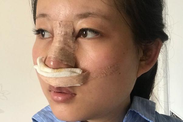 耳軟骨隆鼻會(huì)增生嗎 耳軟骨隆鼻會(huì)變低嗎 耳軟骨隆鼻會(huì)增生嗎 耳軟骨隆鼻會(huì)變低嗎