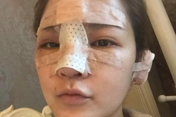 耳軟骨隆鼻有什么后遺癥 耳軟骨隆鼻有點歪可以調整嗎