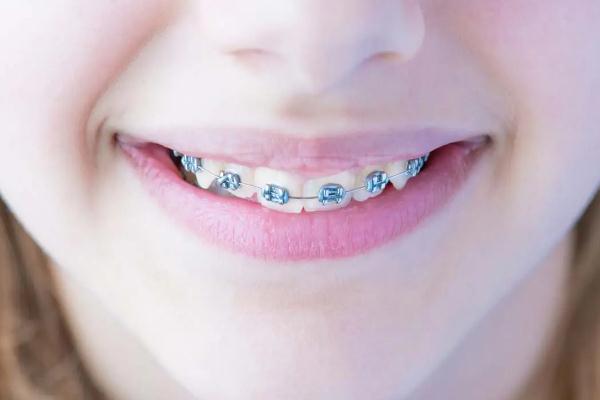 牙套多大年齡可以戴 3歲小孩可以戴牙套嗎 牙套多大年齡可以戴 3歲小孩可以戴牙套嗎