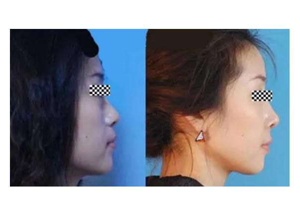 膨體隆鼻感染有什么癥狀 膨體隆鼻感染幾率 膨體隆鼻感染有什么癥狀 膨體隆鼻感染幾率