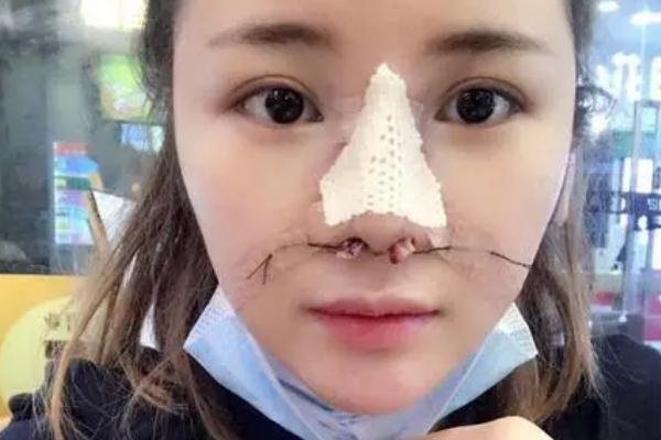 膨體隆鼻感染有什么癥狀 膨體隆鼻感染幾率 膨體隆鼻感染有什么癥狀 膨體隆鼻感染幾率