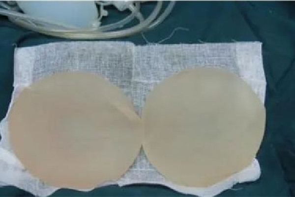 假體隆胸可以一輩子不取出來嗎 假體隆胸是怎么放進(jìn)去的 假體隆胸可以一輩子不取出來嗎 假體隆胸是怎么放進(jìn)去的