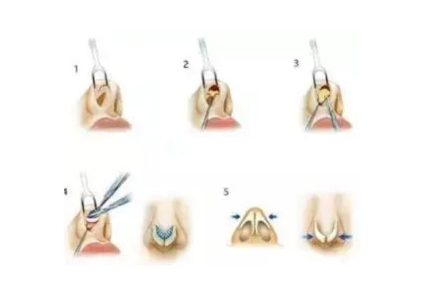 膨體隆鼻可以一輩子不取出來(lái)嗎 膨體隆鼻可以維持多少年