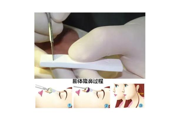 膨體隆鼻可以一輩子不取出來(lái)嗎 膨體隆鼻可以維持多少年