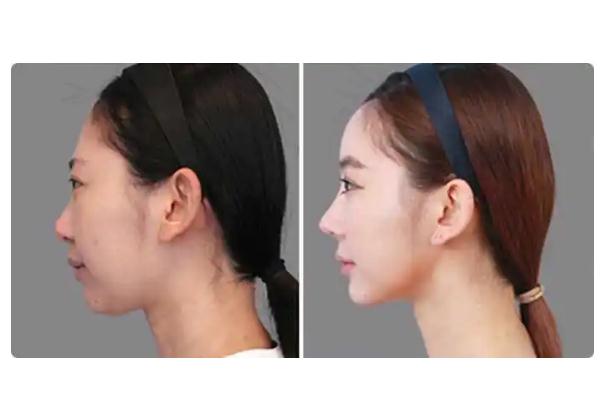 墊下巴什么方式最安全永久 墊下巴手術(shù)風(fēng)險大嗎 墊下巴什么方式最安全永久 墊下巴手術(shù)風(fēng)險大嗎