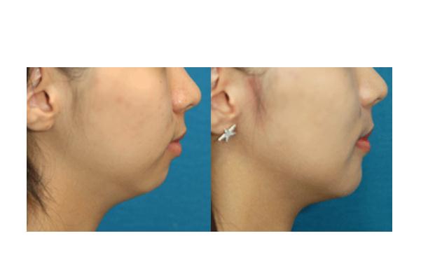 墊下巴什么方式最安全永久 墊下巴手術(shù)風(fēng)險大嗎 墊下巴什么方式最安全永久 墊下巴手術(shù)風(fēng)險大嗎