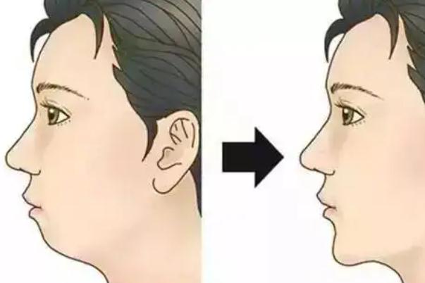 墊下巴痛不痛 墊下巴的效果 墊下巴痛不痛 墊下巴的效果