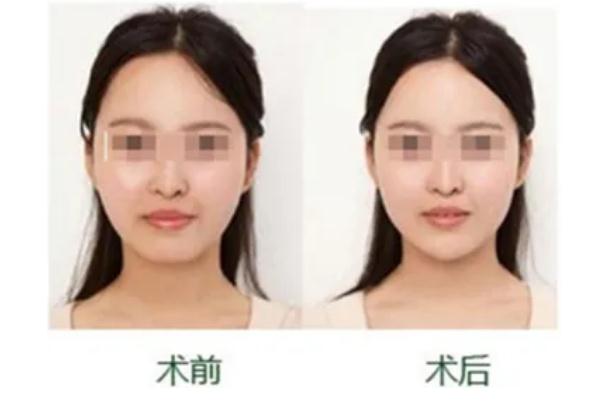 豐下巴會不會產生木偶紋 豐下巴會不會臉部下垂 豐下巴會不會產生木偶紋 豐下巴會不會臉部下垂