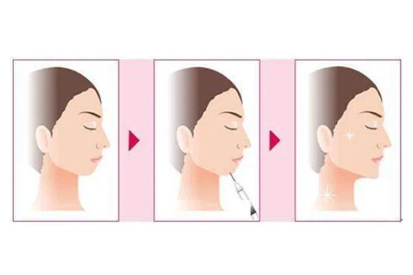 豐下巴是永久的嗎 豐下巴是從正面還是側面 豐下巴是永久的嗎 豐下巴是從正面還是側面