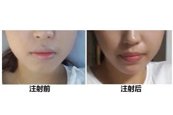 玻尿酸豐下巴多久恢復(fù)自然 玻尿酸豐下巴后遺癥 玻尿酸豐下巴多久恢復(fù)自然 玻尿酸豐下巴后遺癥