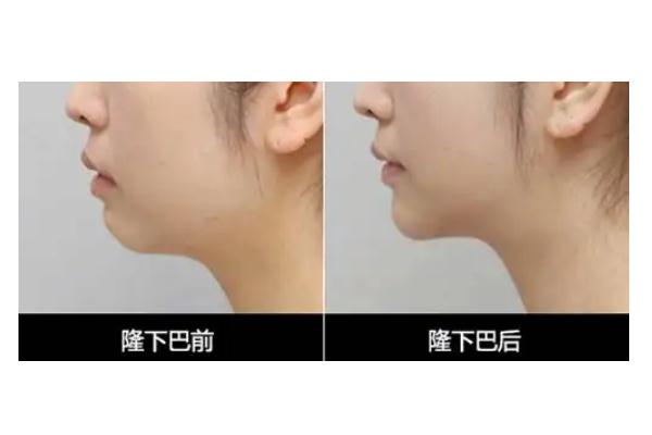 豐下巴哪種方法最好 豐下巴需要多少錢(qián) 豐下巴哪種方法最好 豐下巴需要多少錢(qián)