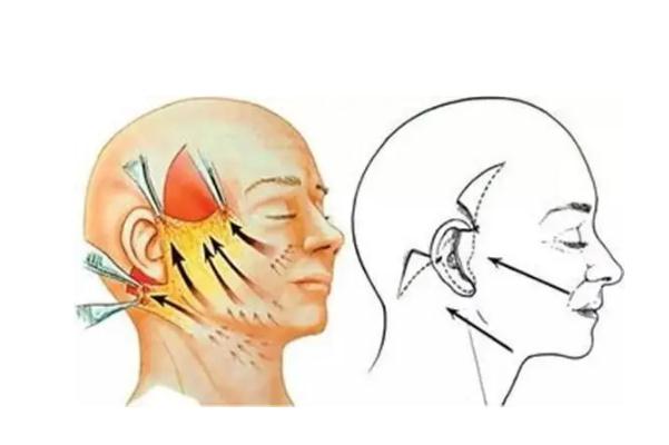 拉皮手術是拉的筋膜層還是皮膚層 拉皮手術是大手術嗎
