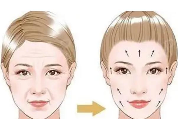 拉皮手術是拉的筋膜層還是皮膚層 拉皮手術是大手術嗎