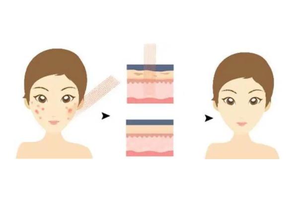 激光祛痘有副作用么 激光祛痘有后遺癥嗎 激光祛痘有副作用么 激光祛痘有后遺癥嗎