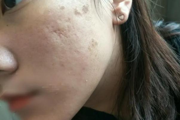 紅藍(lán)光祛痘的作用及副作用 紅藍(lán)光祛痘到底有沒有效果