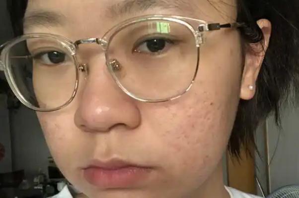 紅藍(lán)光祛痘的作用及副作用 紅藍(lán)光祛痘到底有沒有效果