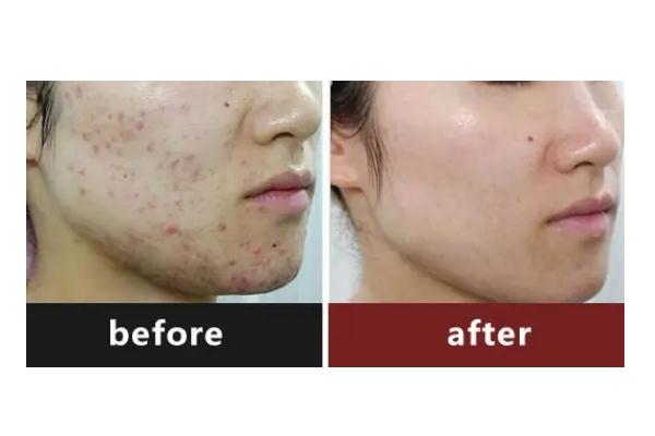 激光祛痘要滿(mǎn)多少歲 激光祛痘要多久恢復(fù) 激光祛痘要滿(mǎn)多少歲 激光祛痘要多久恢復(fù)