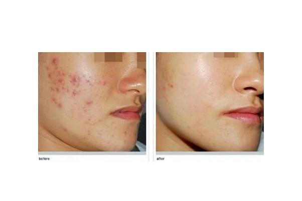 激光祛痘會留疤嗎 激光祛痘會再次復發(fā)嗎 激光祛痘會留疤嗎 激光祛痘會再次復發(fā)嗎