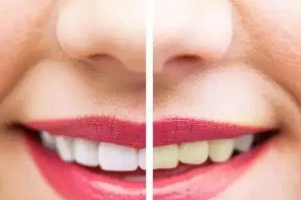 冷光美白牙齒會(huì)很白嗎 冷光美白牙齒對(duì)四環(huán)素牙有用嗎