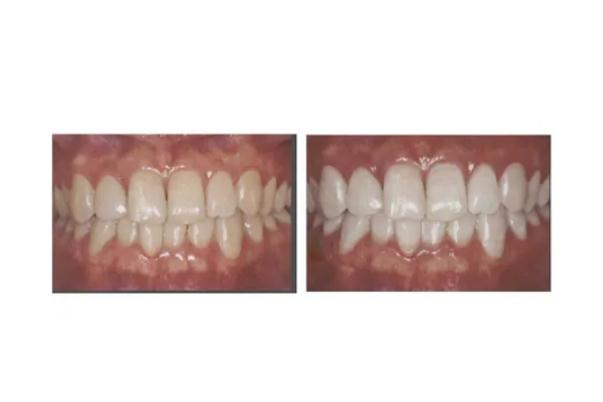 冷光美白牙齒是全口嗎 什么是牙齒冷光美白 冷光美白牙齒是全口嗎 什么是牙齒冷光美白