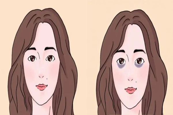 填淚溝和去眼袋是一回事嗎 填淚溝后有硬塊正常嗎