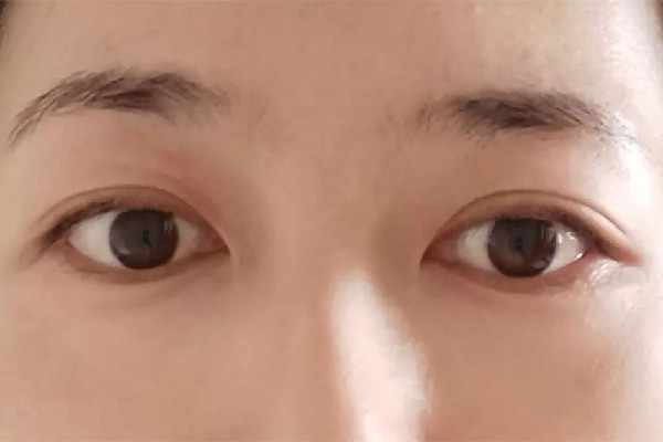 淚溝填充后黑眼圈重怎么回事 淚溝填充后怎么護(hù)理 淚溝填充后黑眼圈重怎么回事 淚溝填充后怎么護(hù)理