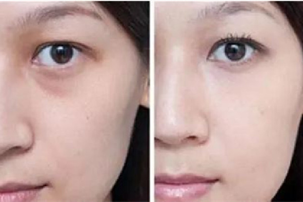 淚溝填充失敗怎么修復(fù) 淚溝填充后多久能看到效果 淚溝填充失敗怎么修復(fù) 淚溝填充后多久能看到效果