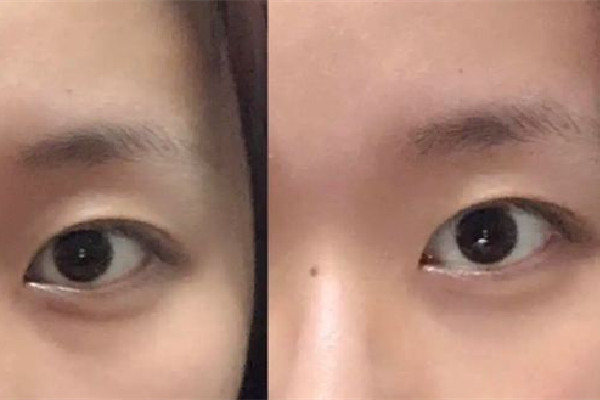 填淚溝是膠原蛋白好還是玻尿酸好 填淚溝需要注意什么 填淚溝是膠原蛋白好還是玻尿酸好 填淚溝需要注意什么