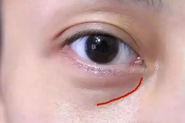 淚溝填充可以維持多久 淚溝填充多久才能恢復自然 淚溝填充可以維持多久 淚溝填充多久才能恢復自然