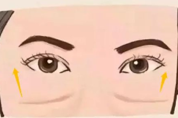 填淚溝和去眼袋是一回事嗎 填淚溝后有硬塊正常嗎 填淚溝和去眼袋是一回事嗎 填淚溝后有硬塊正常嗎