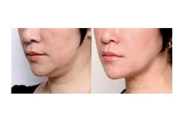 溶脂針是肉毒素嗎 溶脂針是瘦臉針嗎 溶脂針是肉毒素嗎 溶脂針是瘦臉針嗎