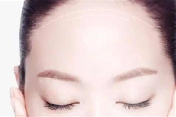 額頭填充一般要多少錢(qián) 額頭填充去什么醫(yī)院 額頭填充一般要多少錢(qián) 額頭填充去什么醫(yī)院