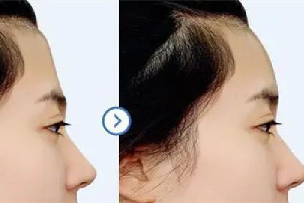 額頭填充一般要多少錢(qián) 額頭填充去什么醫(yī)院 額頭填充一般要多少錢(qián) 額頭填充去什么醫(yī)院