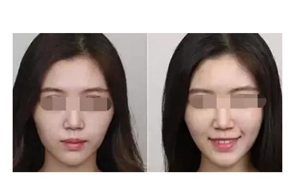 蘋果肌復位的注意事項 蘋果肌復位后要戴面罩嗎