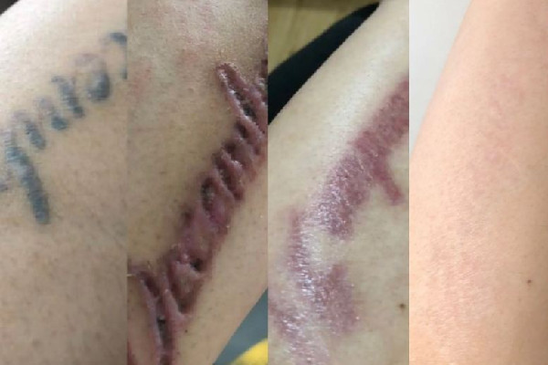 洗紋身會不會留疤 洗紋身后要注意什么 洗紋身會不會留疤 洗紋身后要注意什么