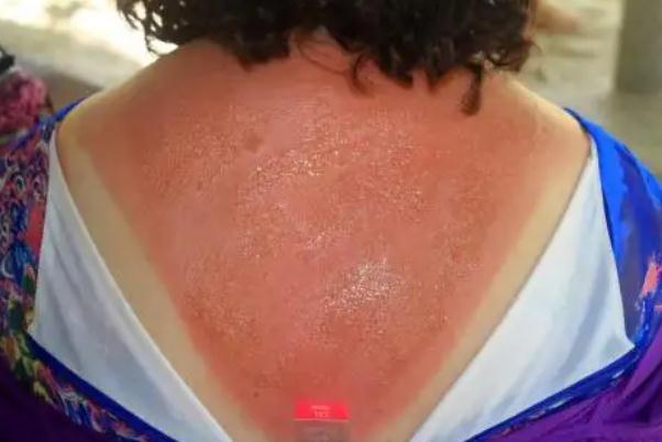 皮膚曬傷發(fā)紅怎么修復 皮膚曬傷怎么處理最好