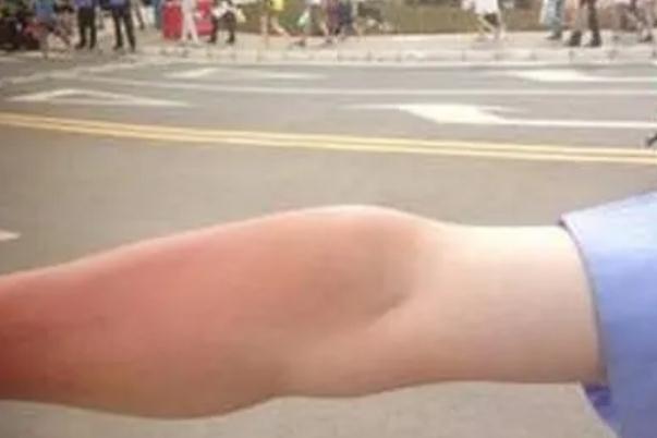 皮膚曬傷發(fā)紅怎么修復 皮膚曬傷怎么處理最好