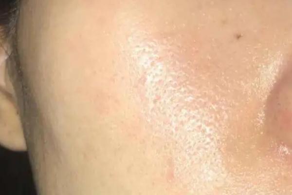 皮膚出油多是什么原因 皮膚出油嚴(yán)重毛孔粗大如何改善 皮膚出油多是什么原因 皮膚出油嚴(yán)重毛孔粗大如何改善